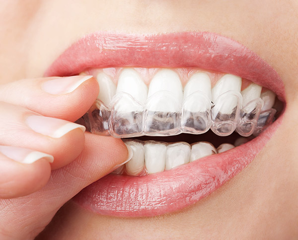 aligners img