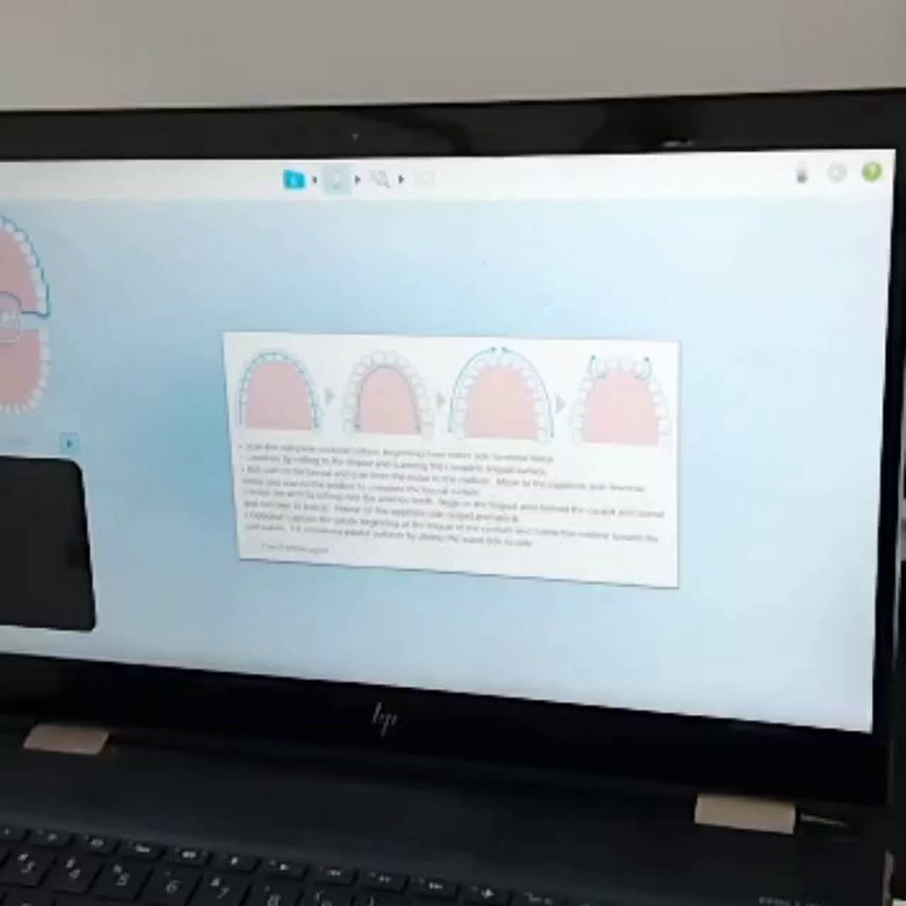 Invisalign on EMI