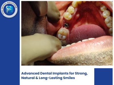 Dental Implants in Thane: Why The Dental Solutions is the Top Dental Clinic in Thane for Lasting Smiles
