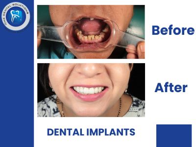 Life After Dental Implants: Real Stories from India’s Best Dentists