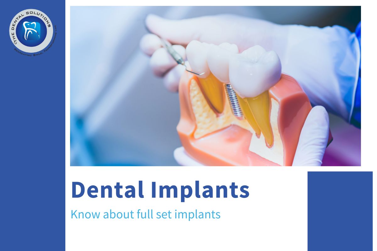 Full Set Implants Treatment Thane