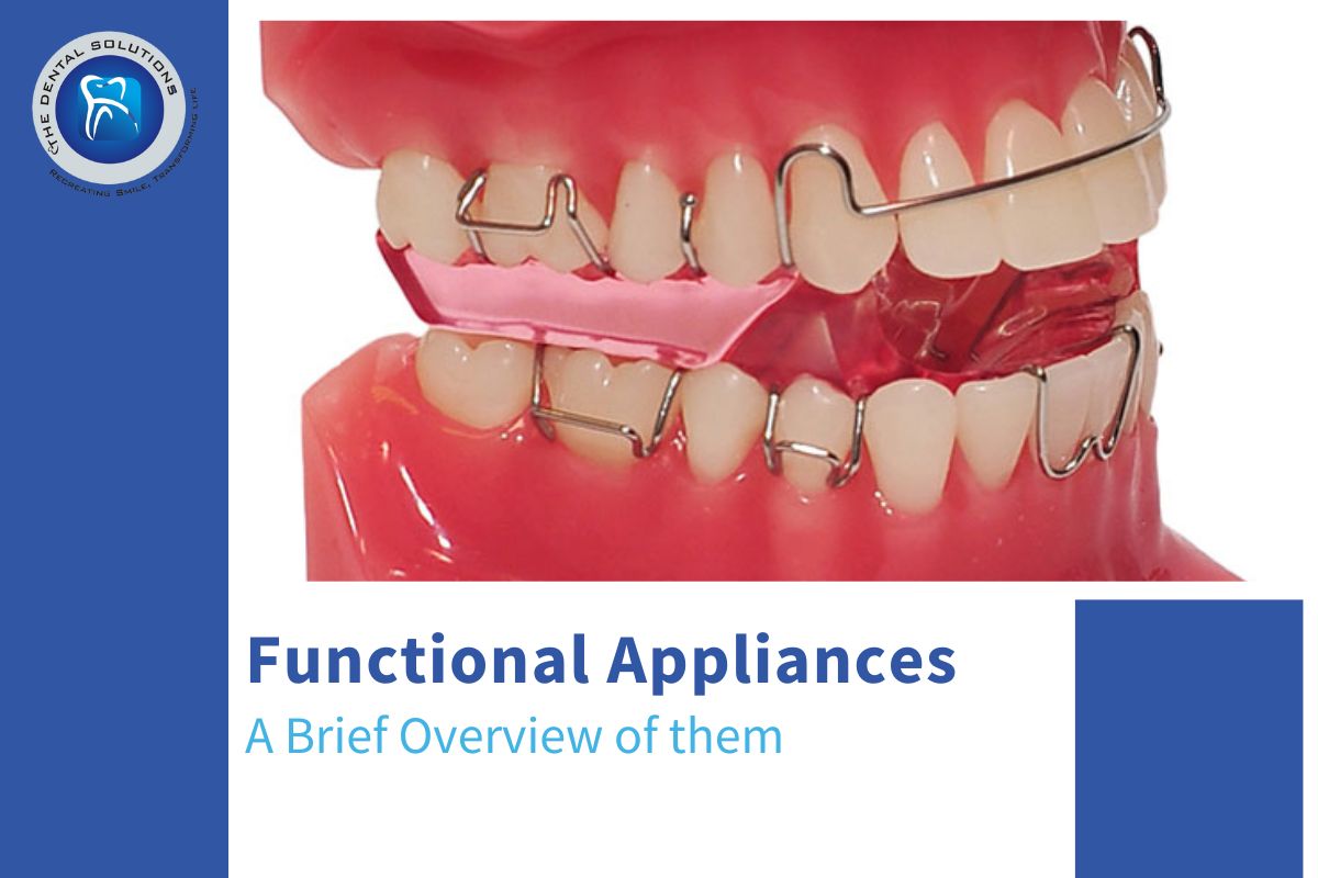A brief overview of Functional Appliances Treatment in Thane
