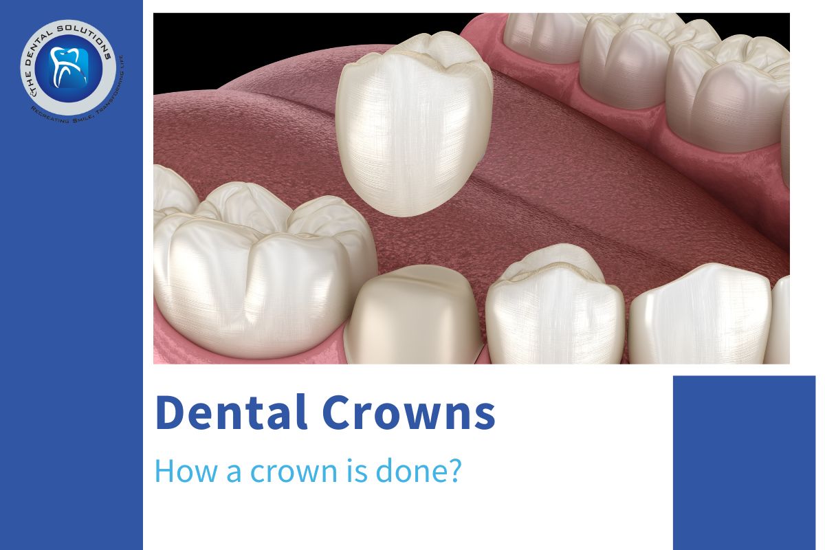 A Step-by-Step Guide to how a crown is done