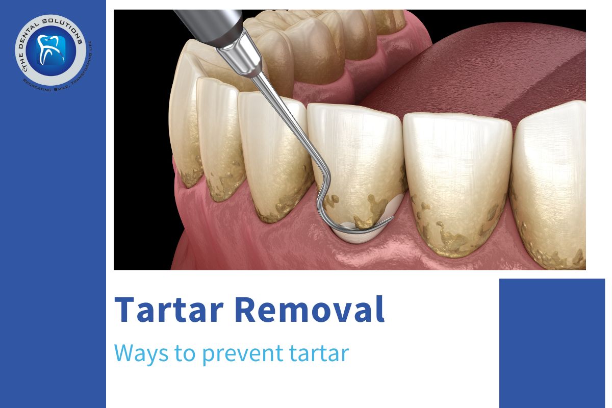 How to Remove Tartar from Teeth at Home