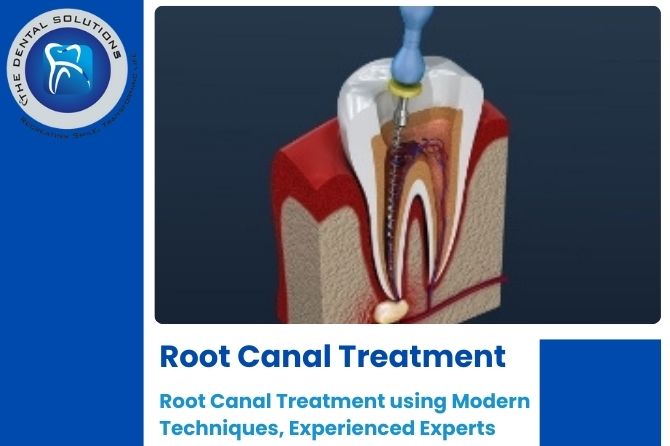 Painless Root Canal Treatment in Thane & Mumbai