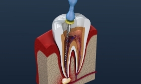 What is the root canal treatment and does it have to be painful?