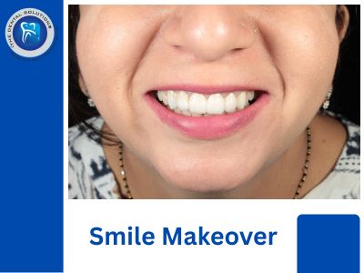 Thinking of a Smile Makeover in Thane? Here’s What the Best Dentists Recommend