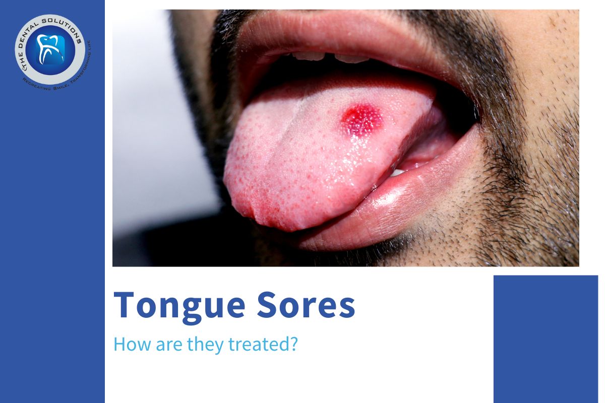 Tongue Sores Treatment Thane