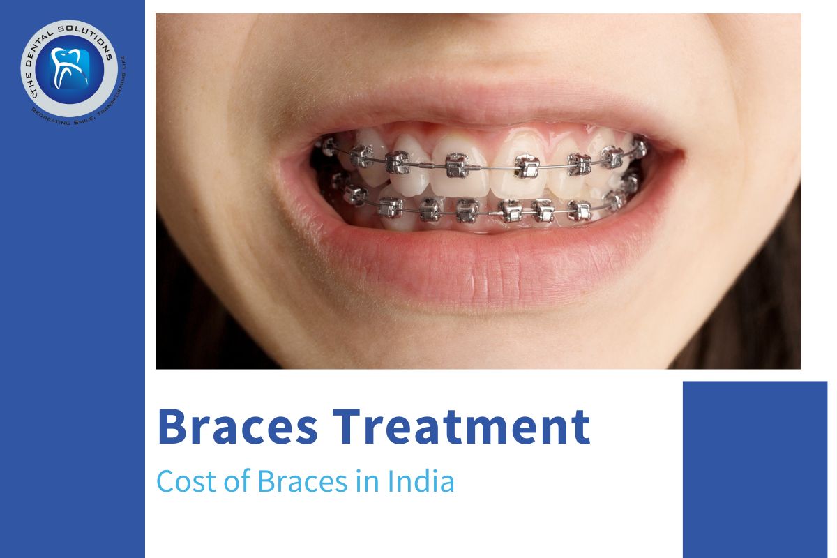 What is the Cost of Braces in India