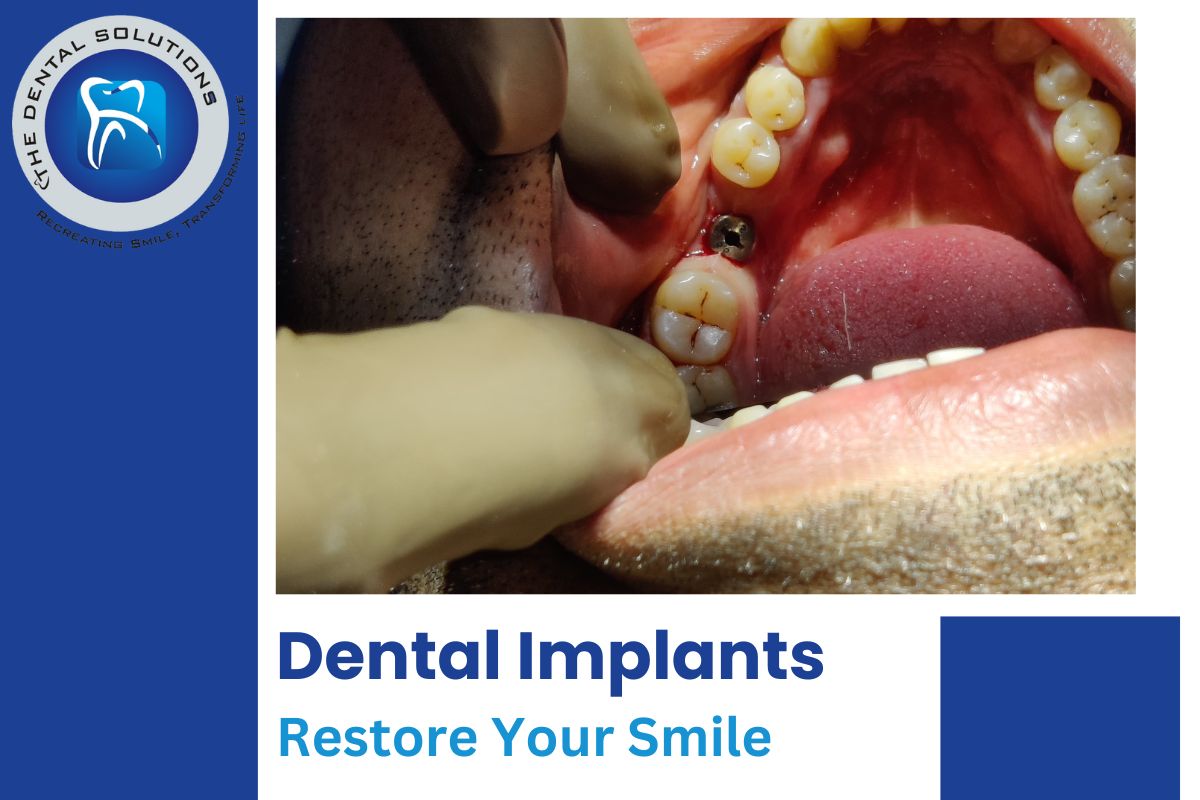 Say Goodbye to Missing Teeth – Advanced Dental Implants in Thane