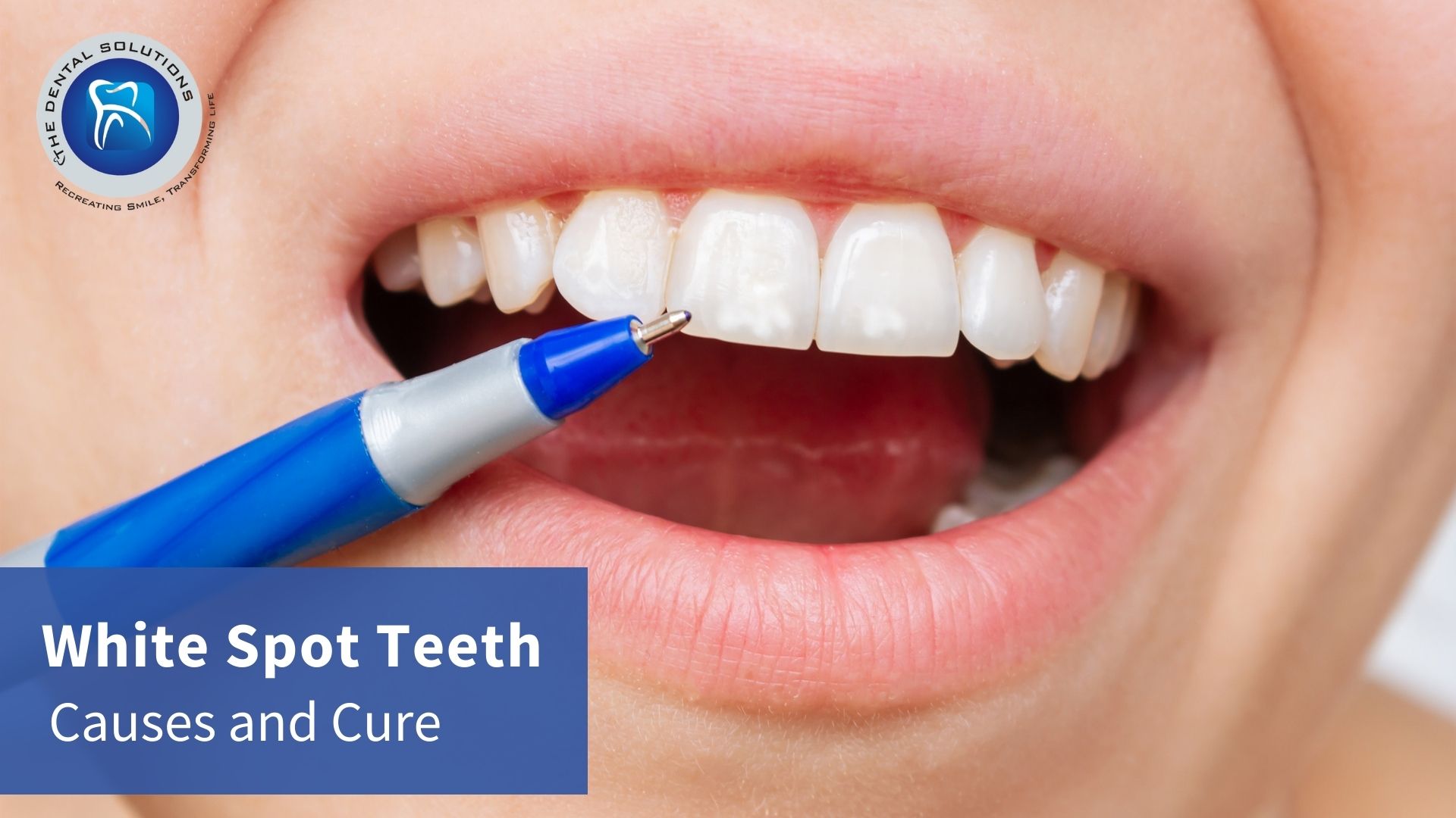 White Spot Teeth - Causes and Cure: White spot Treatment in Thane