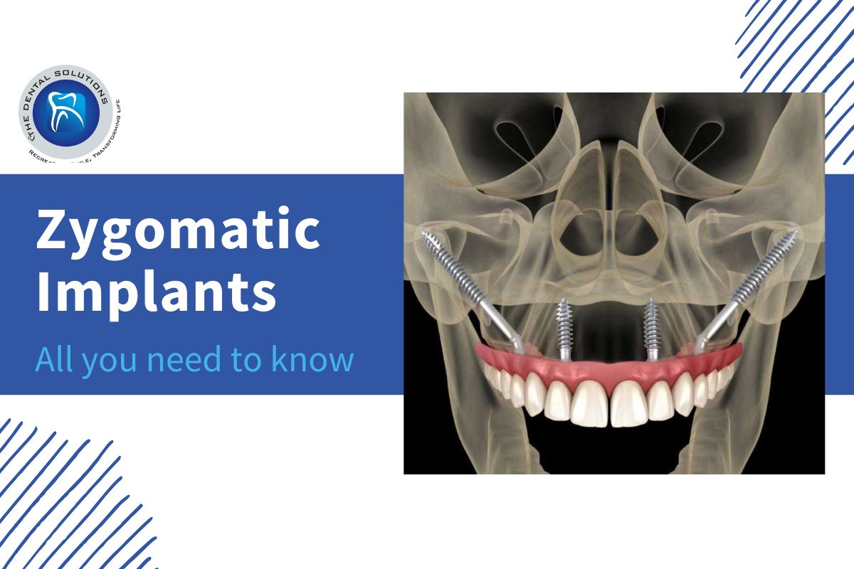All you need to know about Zygomatic Implants Thane