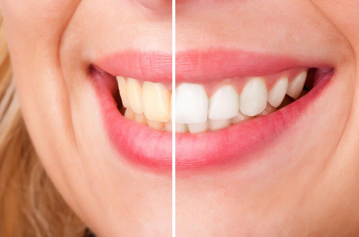 image showing the results from teeth whitening in thane west majiwada
