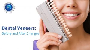 Dental Veneers Before and After Changes After the Treatment