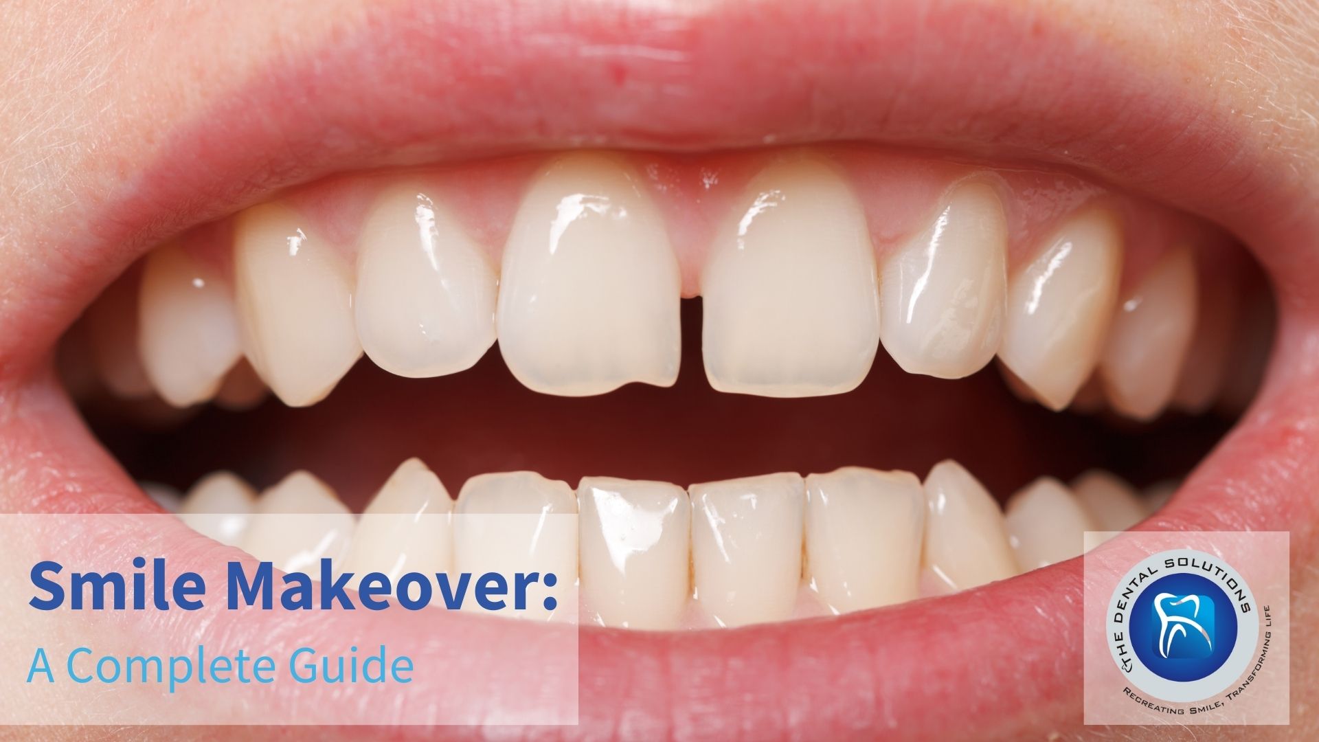 Smile Makeover: The Ultimate Teeth Transformation Guide