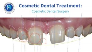 Cosmetic Dental Care: What to Know When Getting Cosmetic Dental Surgery