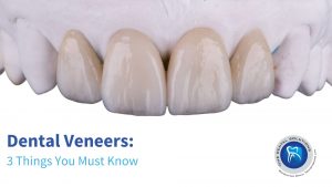 Top 3 Things you should know before getting Dental Veneers