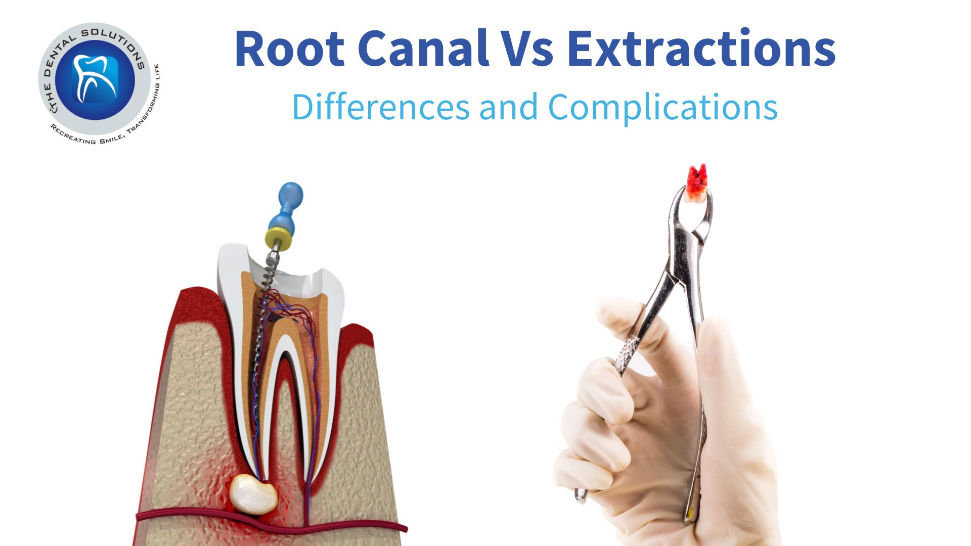 Root Canal vs Extraction: Understanding the Differences and Complications