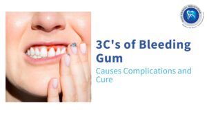 Top 4 Major Causes of Bleeding Gums: Bleeding Gums Treatment in Thane