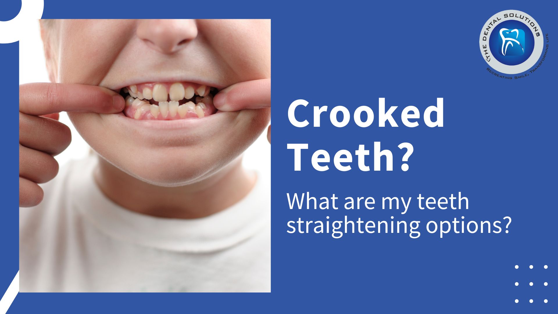 Crooked Teeth? Not Anymore: Teeth Straightening Treatment Thane