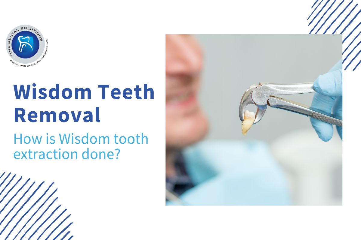 How is extraction done: Wisdom Teeth Removal Thane